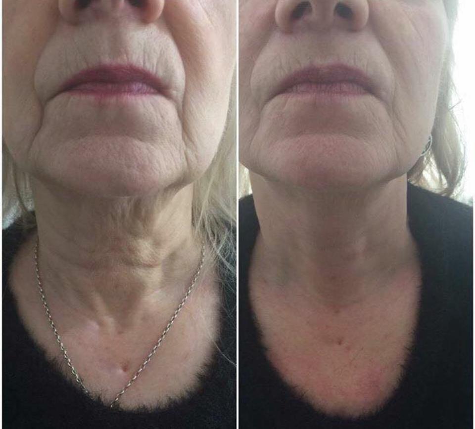 Before and after of a HIFU face treatment at The Body Shaper Calahonda showing a visibly lifted jawline and tighter neck.