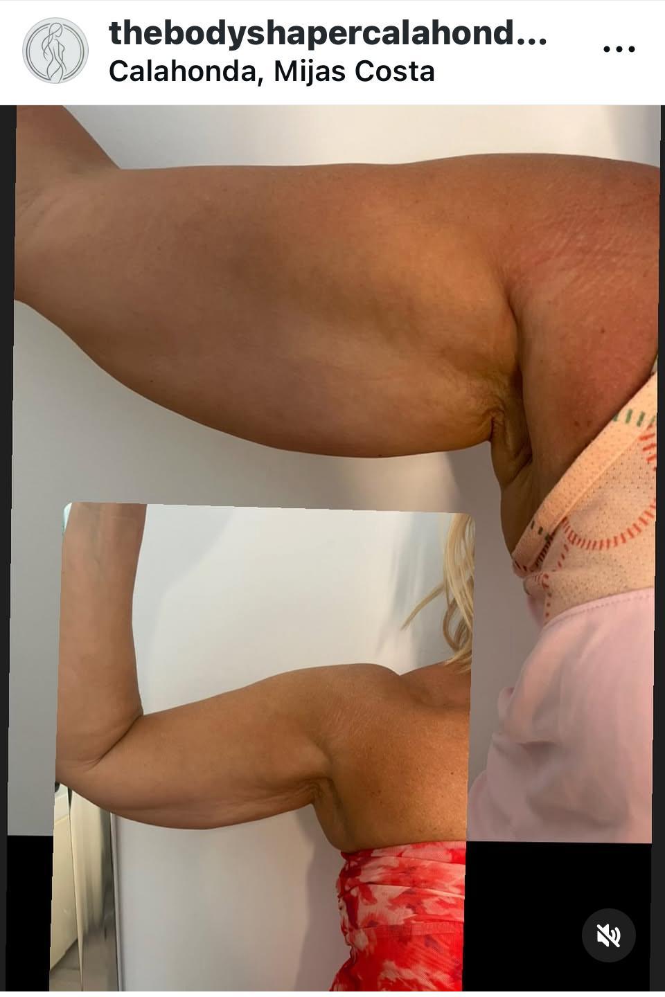 Before and after of a HIFU arms treatment on a mature client showing visibly tighter inner arm skin.